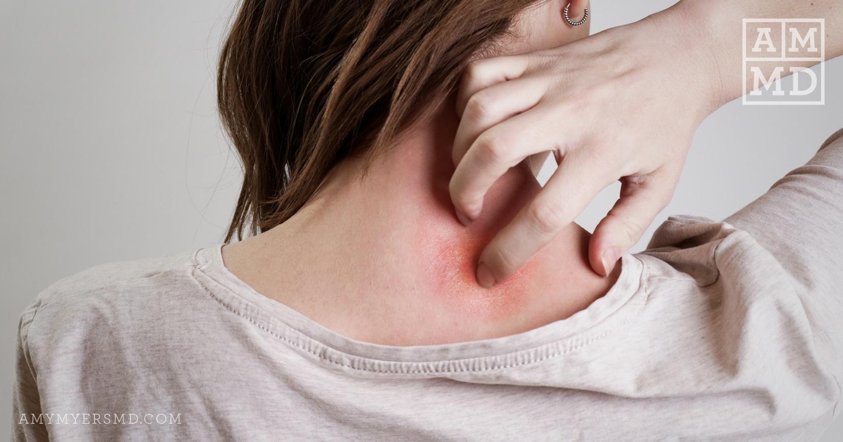 Natural Psoriasis Treatment from the Inside Out - A Woman Scratching a rash on her neck - Featured image - Amy Myers MD®