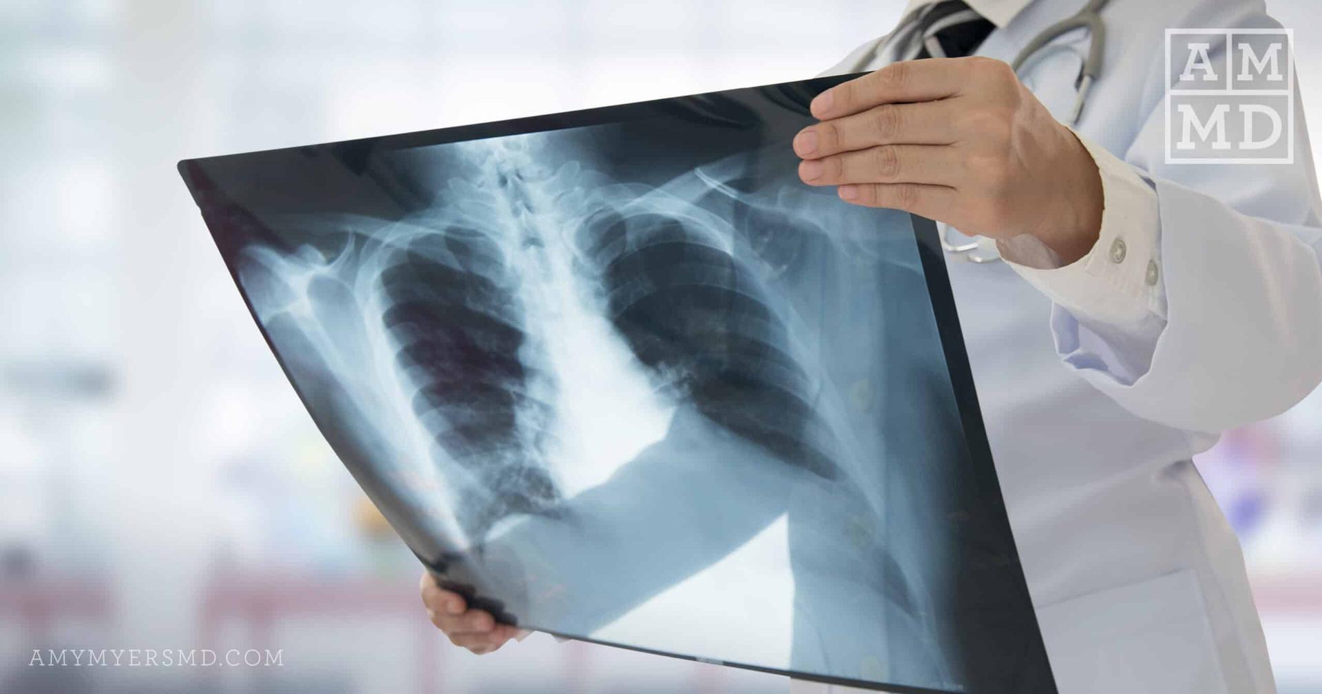 doctor holding a lung x-ray