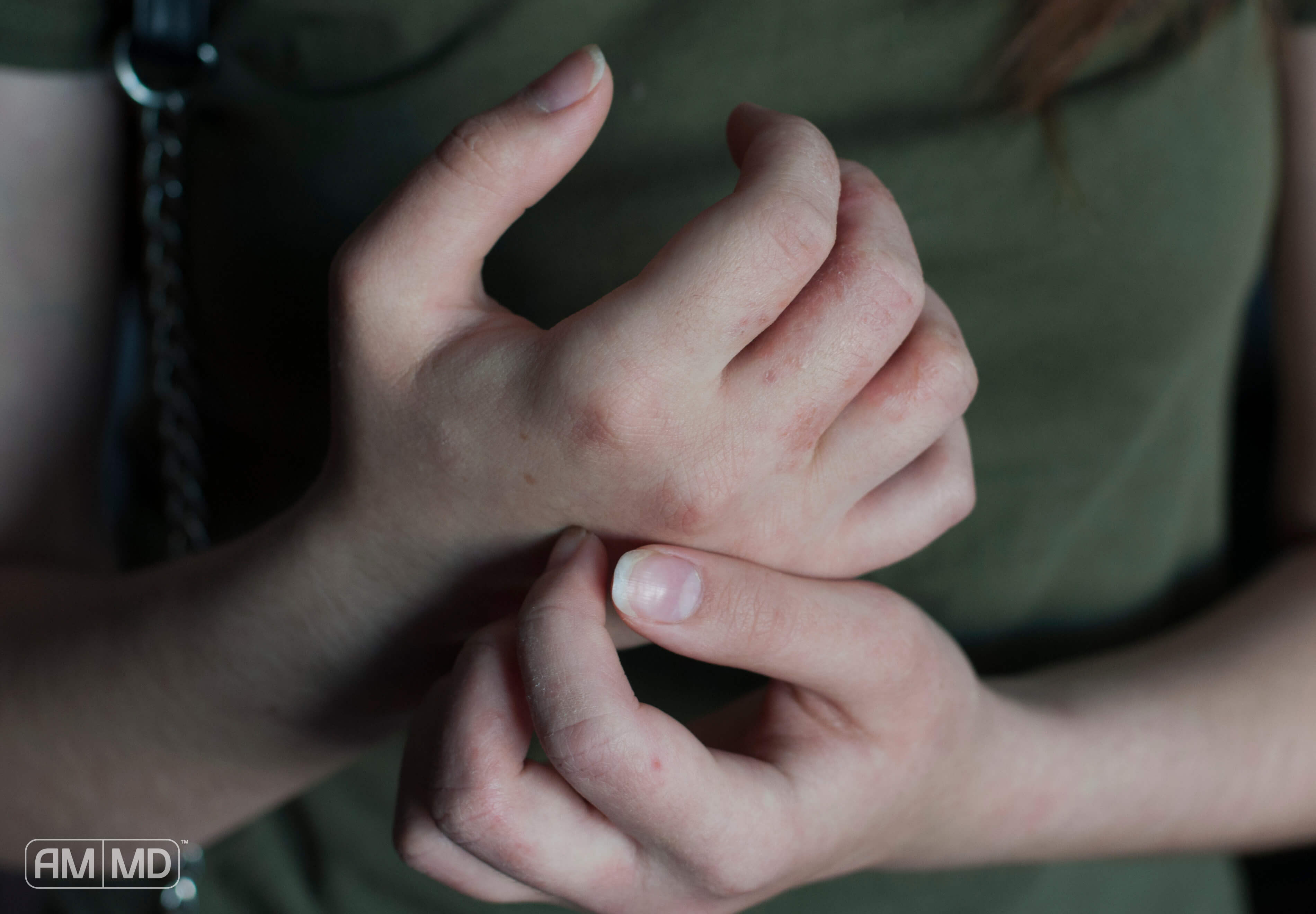 Woman scratching skin on her hands, Are Eczema and Dandruff Signs of Candida Overgrowth?