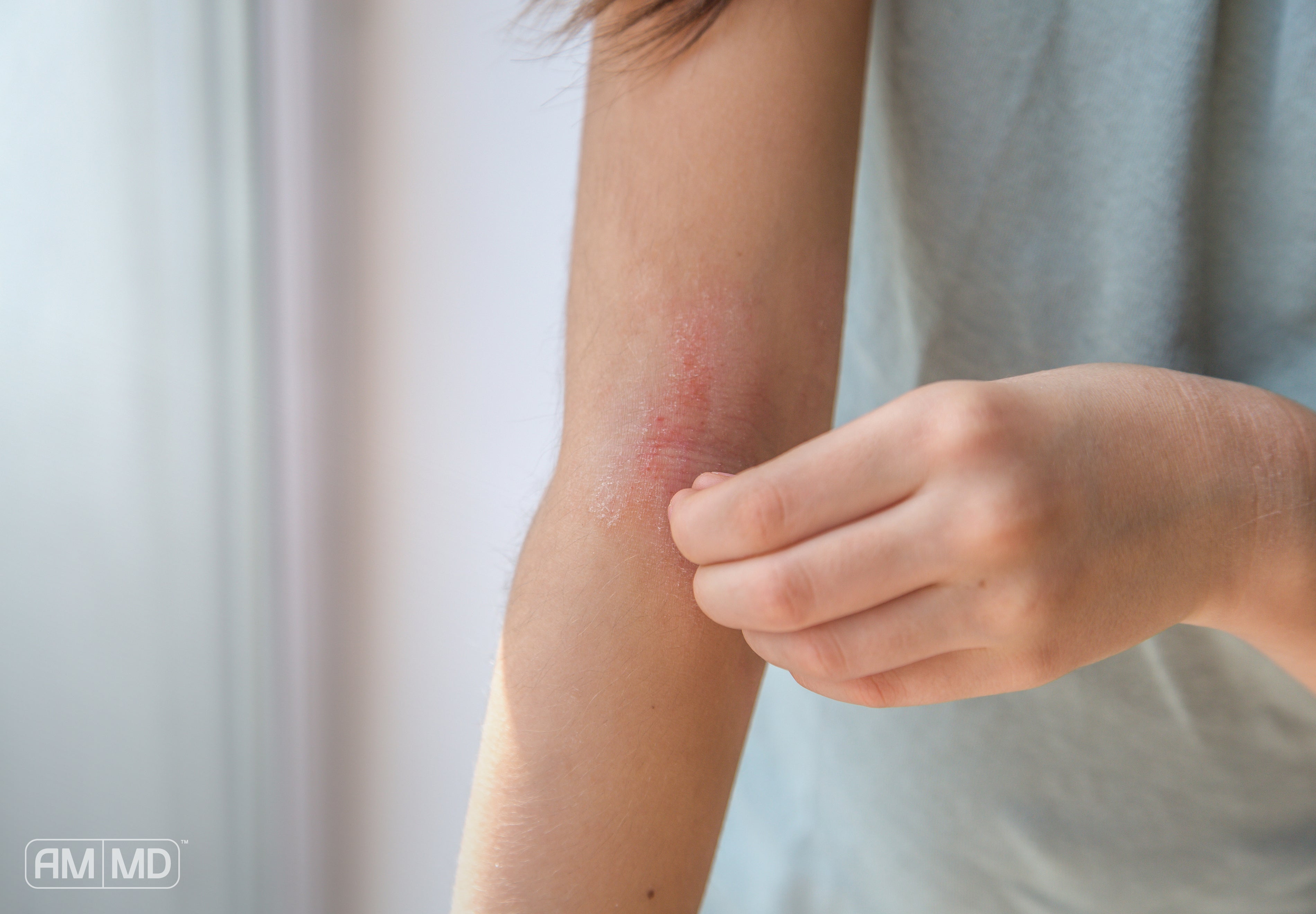 How to Treat Eczema from the Inside Out - Women with red itchy spot on her arm - AMMD™